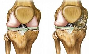 Sinais distintos de artrose articular
