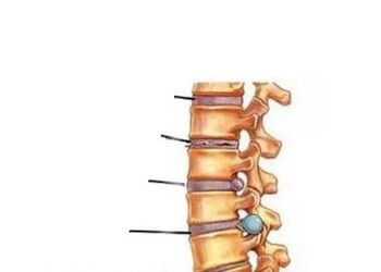 Quatro estágios de desenvolvimento de osteocondrose